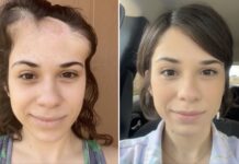 Joven con cáncer documenta su recuperación y sorprende con el resultado