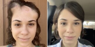 Joven con cáncer documenta su recuperación y sorprende con el resultado