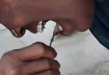 Mujer sufre extraño caso de miasis oral tras infestación de larvas en sus encías