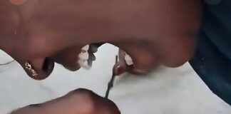 Mujer sufre extraño caso de miasis oral tras infestación de larvas en sus encías